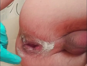 inviting skinny twink with ruptured prolapse makes fisting to himself japan cute happy-go-lucky porn